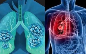 Bác sĩ cảnh báo: Ung thư phổi giai đoạn đầu không phải lúc nào cũng có ho, chú ý 4 bất thường này